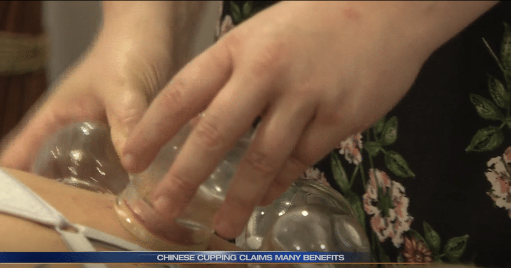 Cupping WSBT