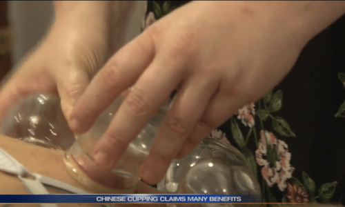 Cupping WSBT